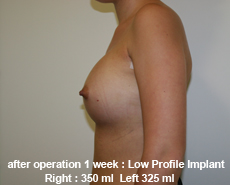plastic-surgery-breast-augmentation